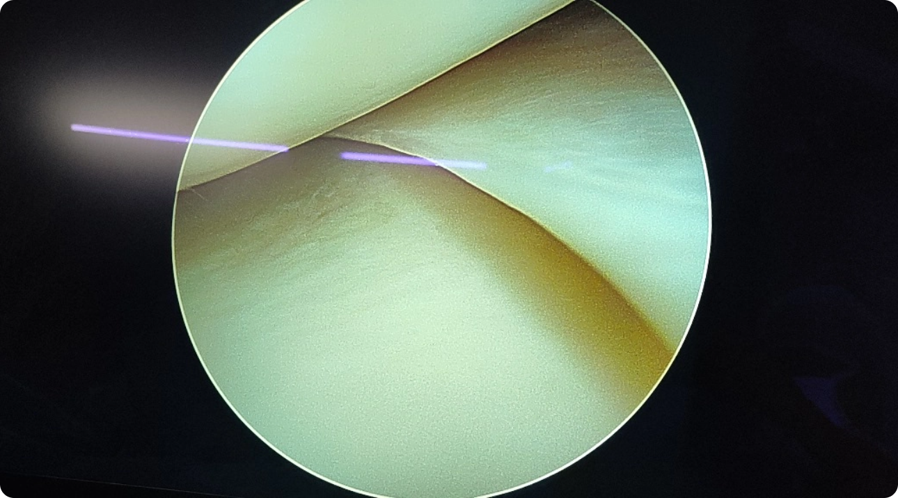 Knee Arthroscopy Doctors in Hyderabad