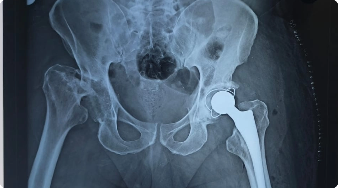 Best Hip Replacement Surgeons in Hyderabad